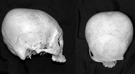 The Enigma Behind the Tiny Cranial Artifact