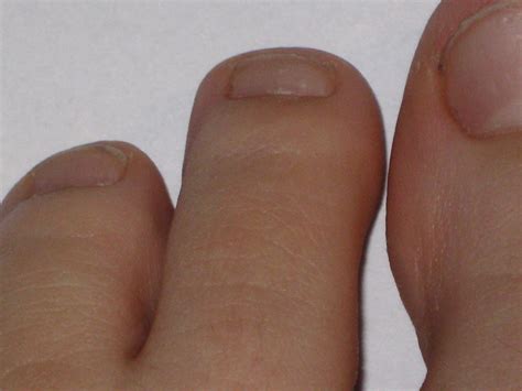 The Enigma of Disappearing Toenails: Unraveling an Intriguing Enigma