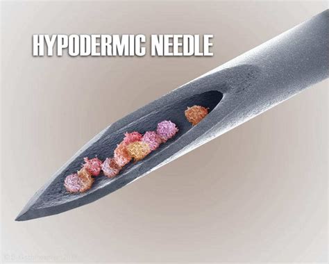 The Enigma of Hidden Needles Beneath the Epidermis