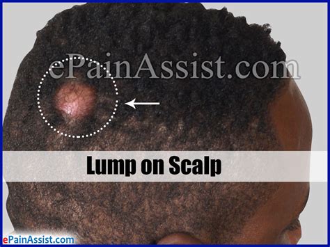 The Enigma of a Lump on Head