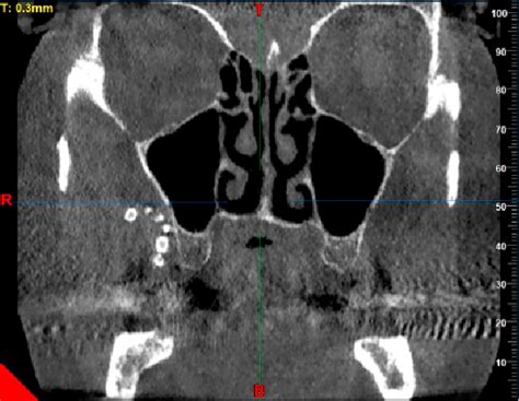 The Enigmatic Realm of Throat Lesion Reveries