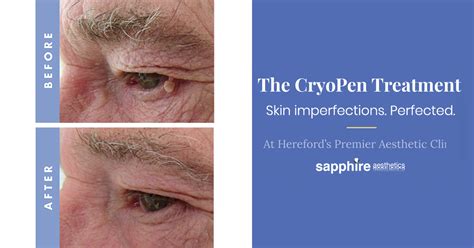 The Enigmatic Significance of Skin Imperfections 