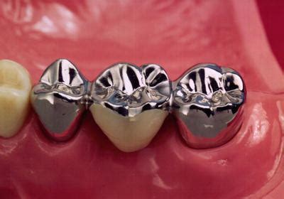 The Evolution and Cultural Importance of Metallic Teeth