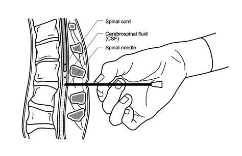 The Fascinating Universe of Needle Puncture Dreams