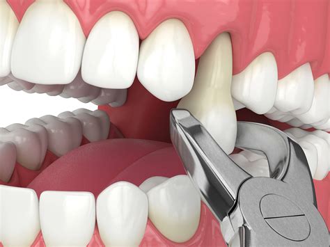 The Frequency of Deaming about Extracting Dental Chewing Substance