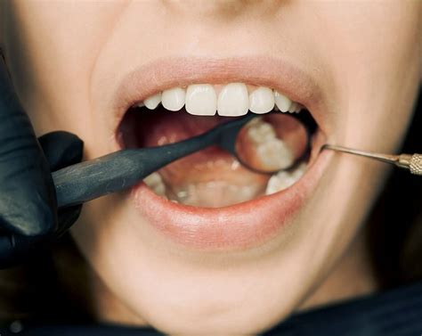 The Frustration of Food Getting Trapped Amidst Dental Cracks