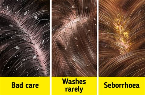 The Hidden Dangers of Severe Dandruff: Why Immediate Action is Crucial