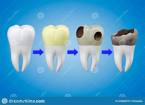 The Impact of Dental Health on Dreams of Deteriorating Teeth