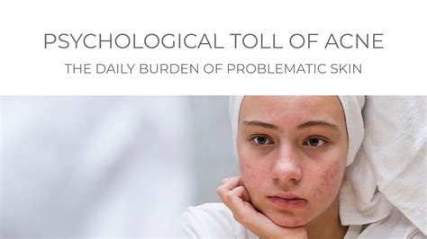 The Impact of Media and Society on Depicting Acne in Dreams