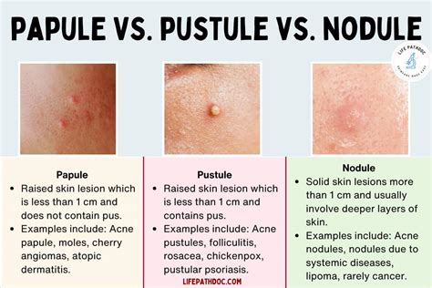 The Impact of Pustule Extraction on Mental Well-being