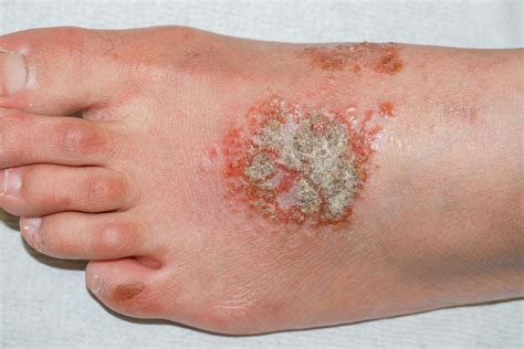 The Impact of Skin Blisters on Daily Life