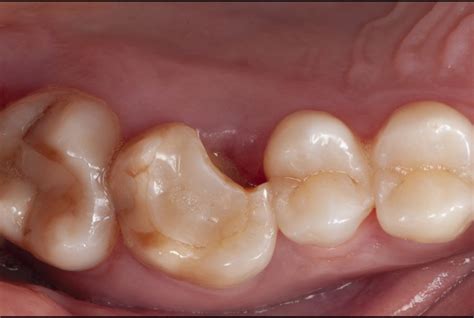 The Impact of Stress and Anxiety on Dreaming About a Fractured Molar