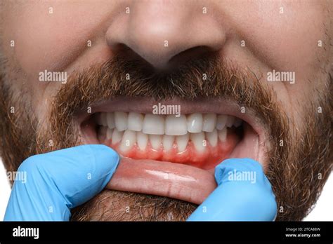 The Impact of Stress and Anxiety on Provoking Inflamed Oral Cavity Night Visions