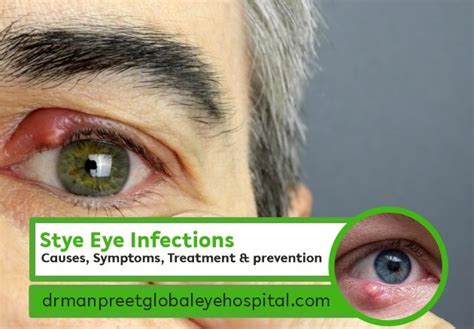 The Impact of Stress on Eye Infections