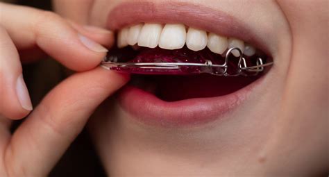 The Importance of Dental Retainers: Maintaining a Perfectly Aligned Smile