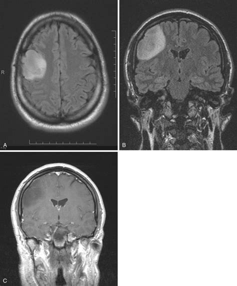 The Intricate World of Intracranial Neoplasms: Grasping the Fundamentals