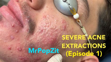 The Intrigue Surrounding Pimple Extraction