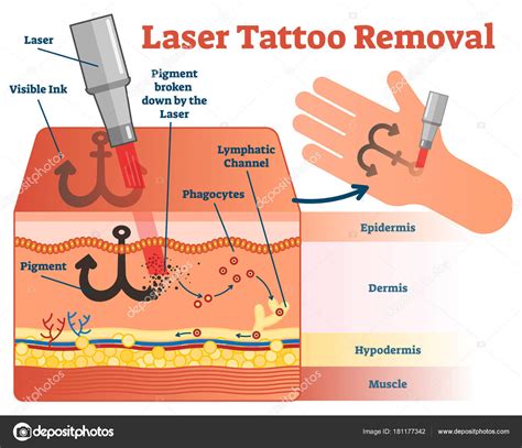 The Laser Tattoo Removal Process: How Does It Work?