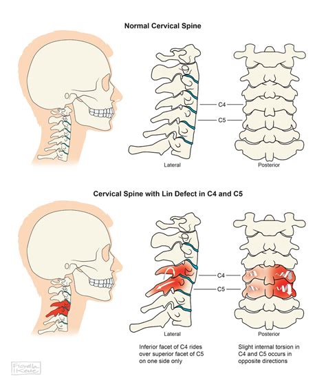 The Link Between Neck Penetration Dreams and Unresolved Distress