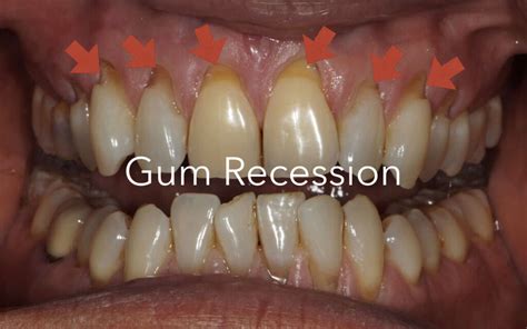 The Main Causes of Gum Recession and How to Prevent Them