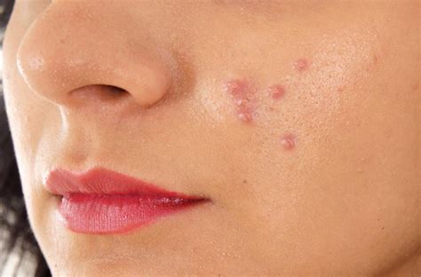 The Origins and Resolutions of Enormous Pimples in Your Nightly Reveries