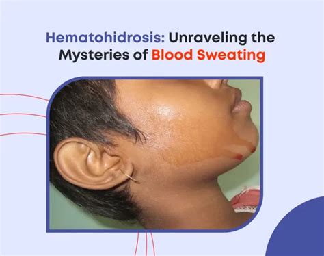 The Phenomenon of Hematohidrosis