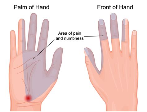 The Physical Manifestation: Decoding the Sensations of an Arachnid Break on the Left Palm