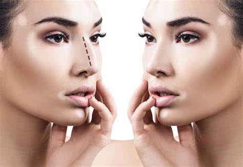 The Power of Rhinoplasty: Transforming Your Nose to Match Your Vision