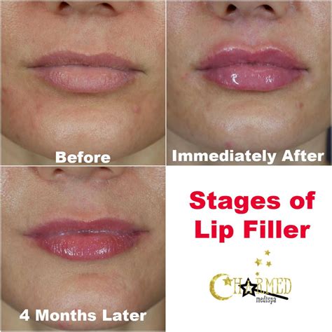 The Process Involved in a Lip Injection Procedure