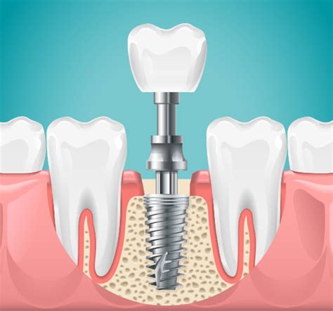 The Pros and Cons of Incorporating Metal Implants