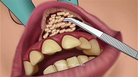 The Psychological Interpretation of Maggots in Teeth