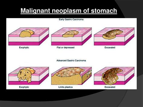 The Psychological Significance of Dreaming about Gastric Neoplasms