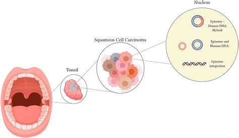 The Role of Human Papillomavirus (HPV) in the Development of Oral Cavity Carcinoma