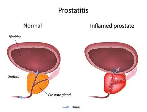 The Role of Prostate Issues in Hematuria