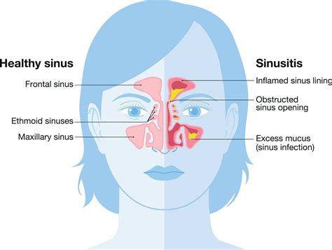 The Role of Sinus Infections in Causing Restricted Breathing during Sleep