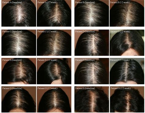 The Science Behind Parting: Understanding Hair Growth Patterns