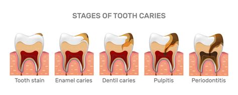 The Significance of Dreams Involving Damaged Enamel