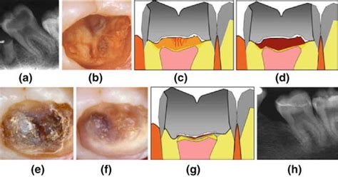 The Significance of Visions about the Removal of Wise Enamel