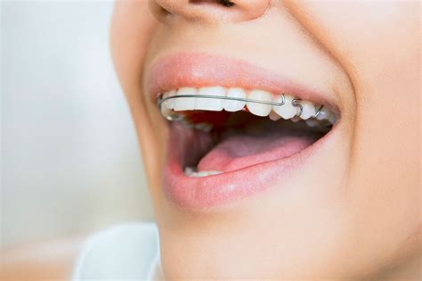 The Significance of Wearing Retainers post-Orthodontic Procedure