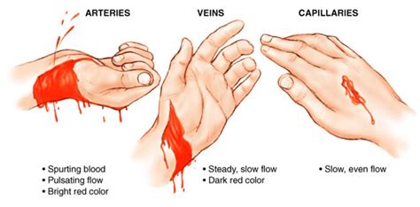 The Significance of Wrist Hemorrhage in Dreams