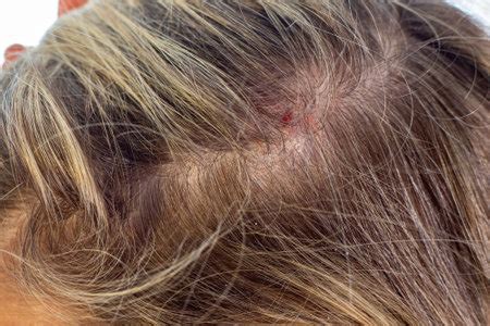 The Significance of a Wound on Your Scalp in Nighttime Reveries