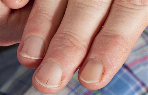 The Structure of a Splintered Nail