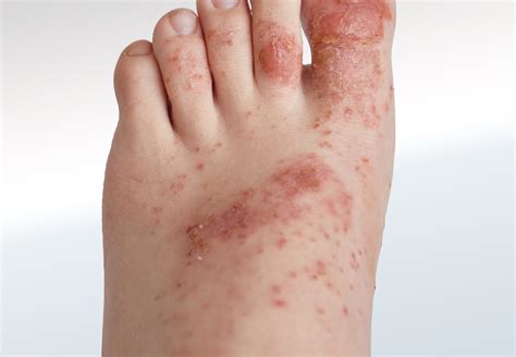 The Surprising Connection Between Foot Rashes in Dreams and Emotional States