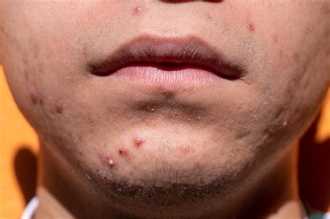 The Symbolic Significance of Dreaming about an Individual with Acne