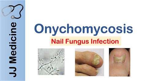 The Telltale Signs: Recognizing the Symptoms of Onychomycosis