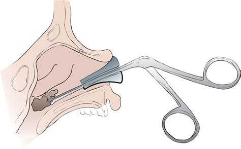 The prevalence of dreams involving extraction of foreign objects from the nasal cavity