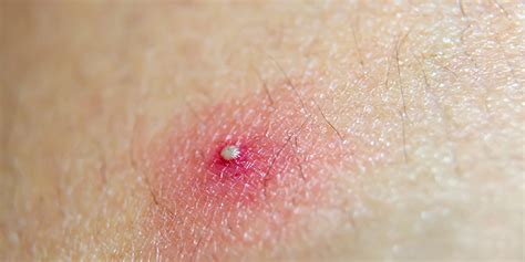 Tips and Remedies to treat Pustules on the Torso