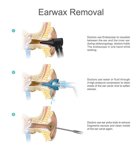 Tips for Coping with Reoccurring Dreams Involving Ear Wax Removal 