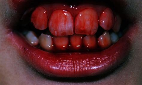 Tips for Dealing with and Overcoming Troubling Nightmares of Bloodied Teeth