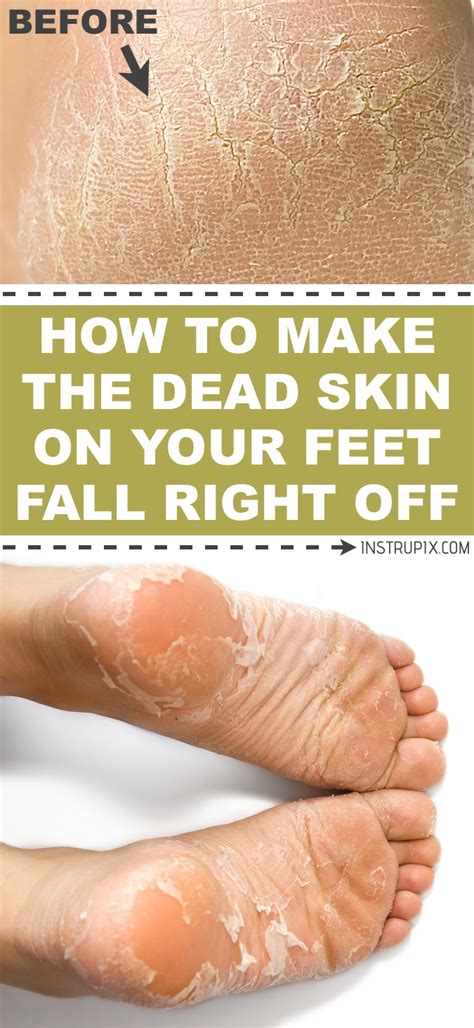 Tips for Preventing Dead Skin Buildup on Feet